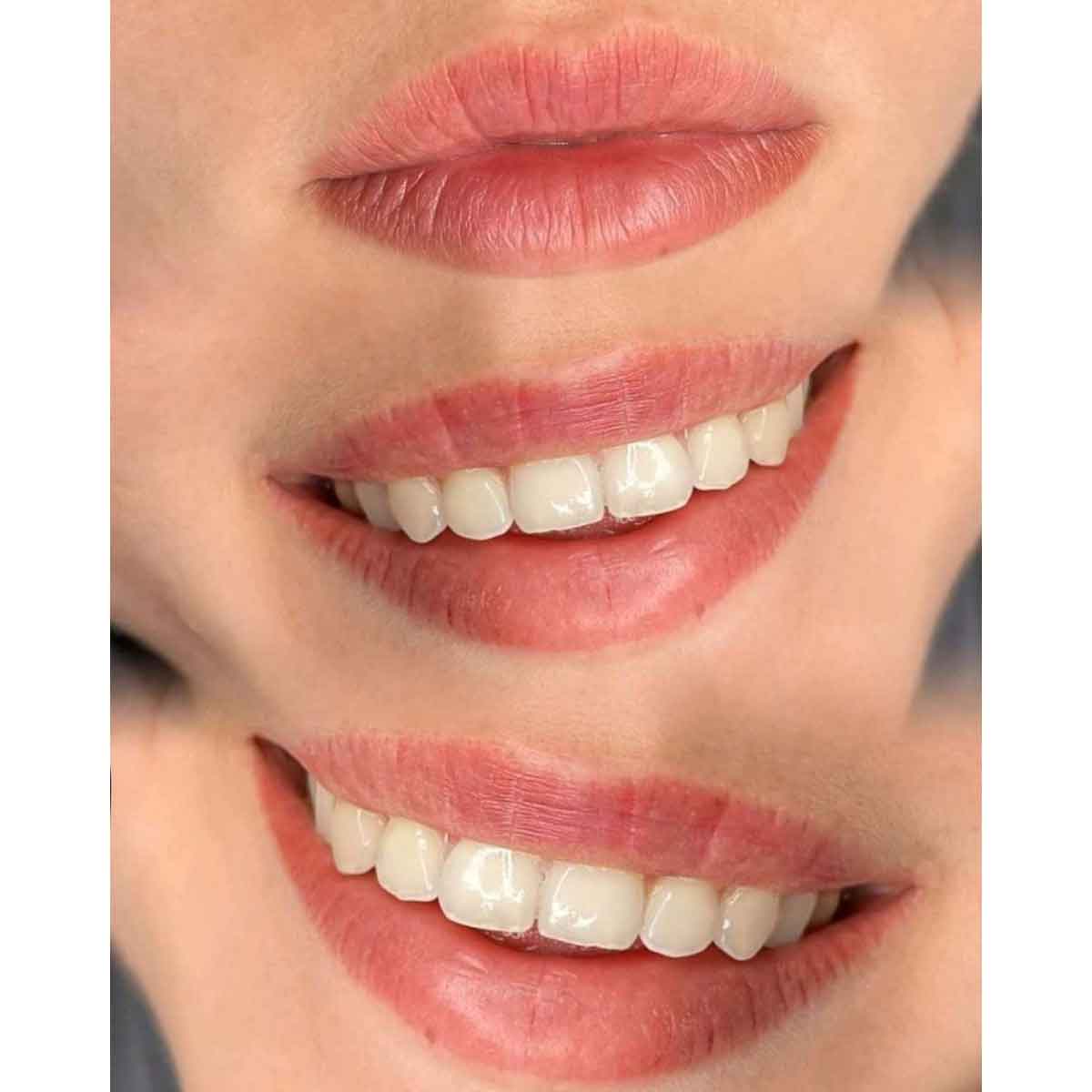 Close-up of a person's mouth area showing natural pink lips and white teeth, likely demonstrating a cosmetic or dental result.
